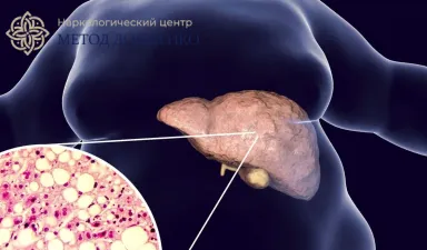 Жировая дегенерация печени в организме человека